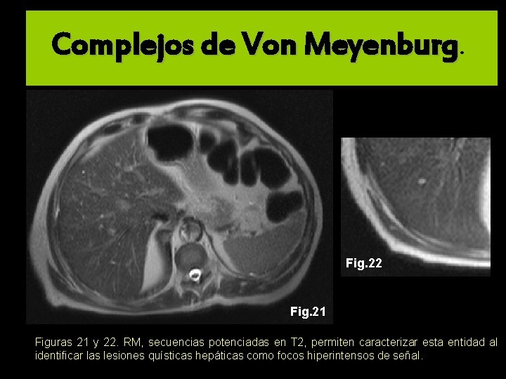 Complejos de Von Meyenburg. Fig. 22 Fig. 21 Figuras 21 y 22. RM, secuencias