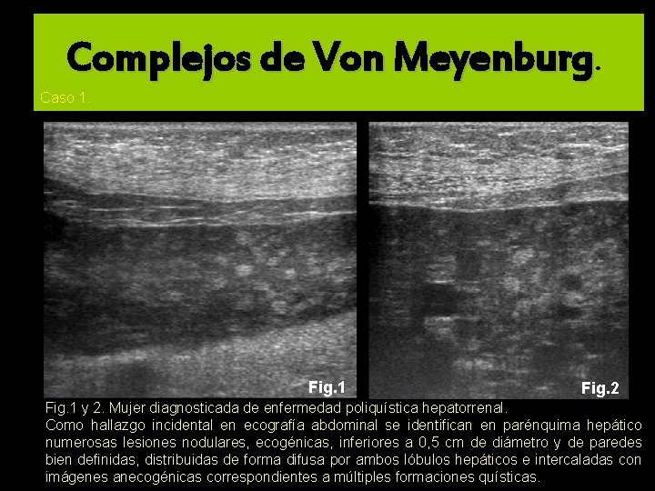 Complejos de Von Meyenburg. Caso 1. Fig. 1 Fig. 2 Fig. 1 y 2.