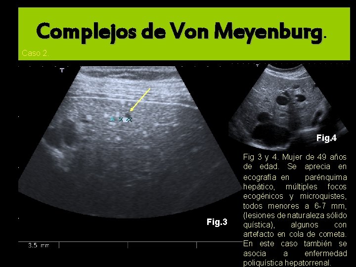Complejos de Von Meyenburg. Caso 2. Fig. 4 Fig. 3 Fig 3 y 4.