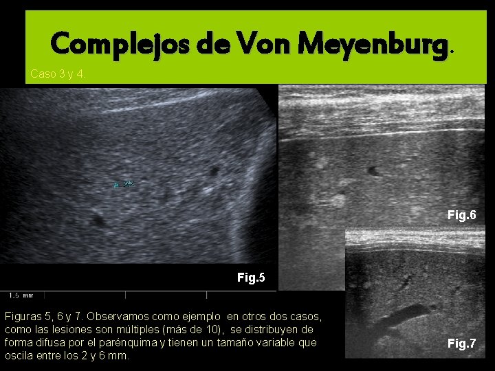 Complejos de Von Meyenburg. Caso 3 y 4. Fig. 6 Fig. 5 Figuras 5,