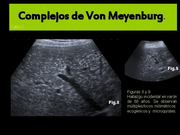 Complejos de Von Meyenburg. Caso 5. delgado Fig. 9 Fig. 8 Figuras 8 y