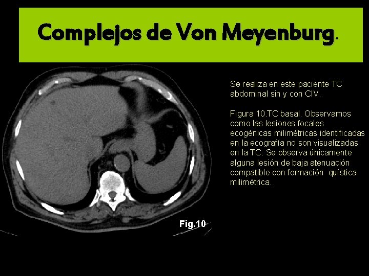Complejos de Von Meyenburg. Se realiza en este paciente TC abdominal sin y con