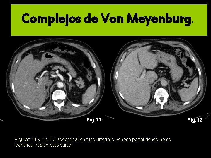 Complejos de Von Meyenburg. delgado Fig. 11 Figuras 11 y 12. TC abdominal en