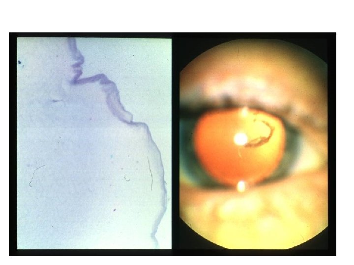 Posterior Vitreous Detachment (PVD) 