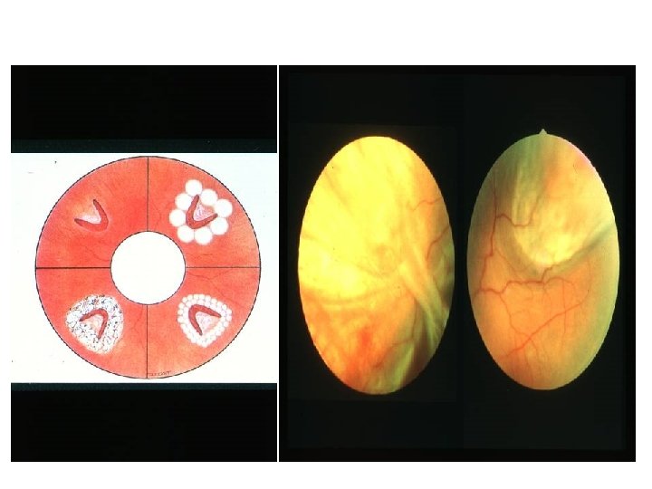 Retinal Tear 