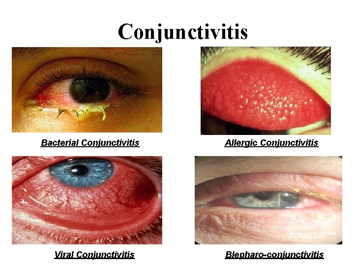 Conjunctivitis Bacterial Conjunctivitis Viral Conjunctivitis Allergic Conjunctivitis Blepharo-conjunctivitis 