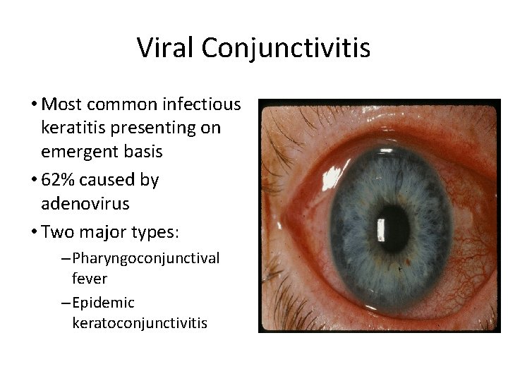 Viral Conjunctivitis • Most common infectious keratitis presenting on emergent basis • 62% caused
