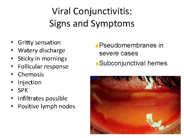Viral Conjunctivitis: Signs and Symptoms • • • Gritty sensation Watery discharge Sticky in