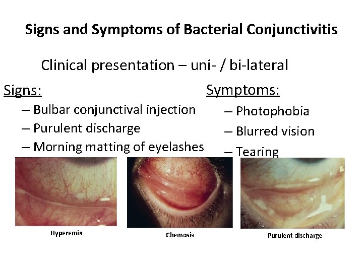 Signs and Symptoms of Bacterial Conjunctivitis Clinical presentation – uni- / bi-lateral Symptoms: Signs: