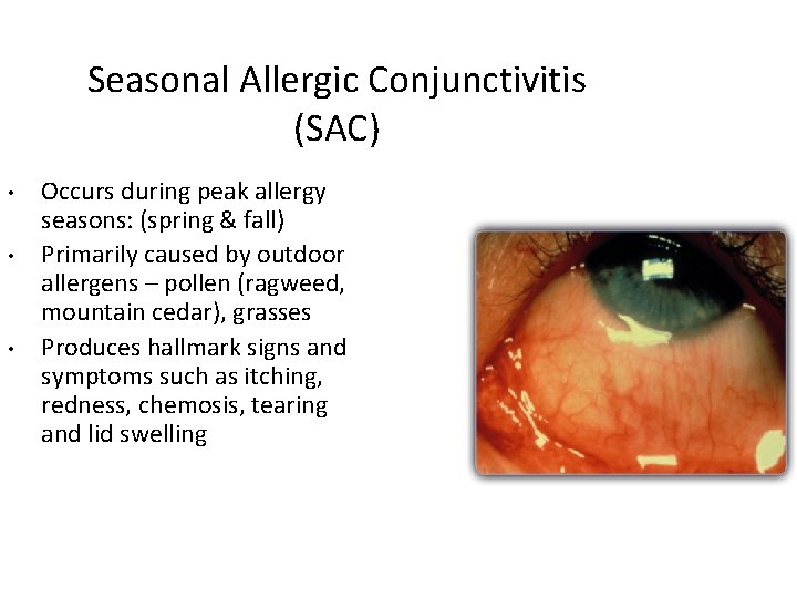 Seasonal Allergic Conjunctivitis (SAC) • • • Occurs during peak allergy seasons: (spring &