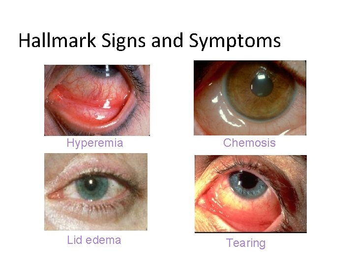 Hallmark Signs and Symptoms Hyperemia Chemosis Lid edema Tearing 