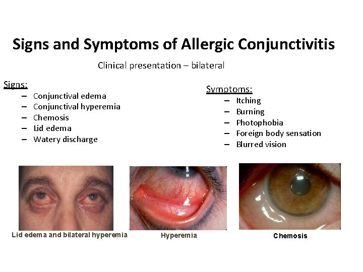 Signs and Symptoms of Allergic Conjunctivitis Clinical presentation – bilateral Signs: – – –