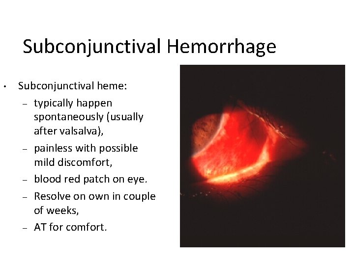 Subconjunctival Hemorrhage • Subconjunctival heme: – typically happen spontaneously (usually after valsalva), – painless