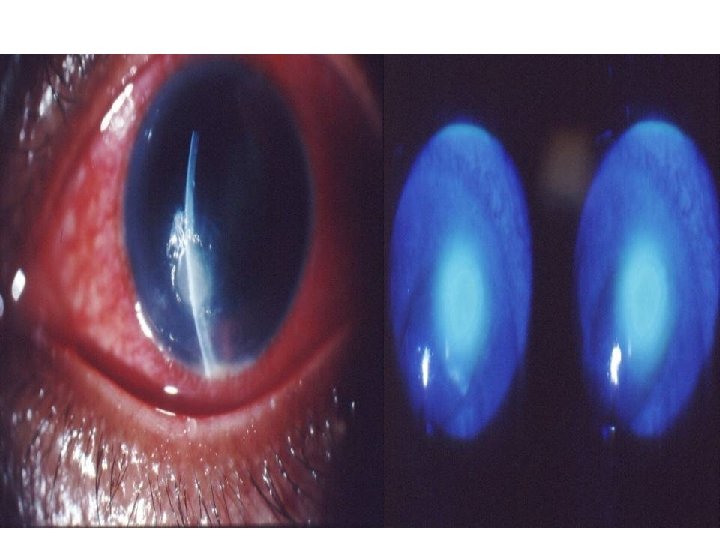 Corneal Ulcer 