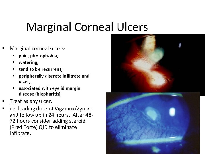 Marginal Corneal Ulcers Marginal corneal ulcerspain, photophobia, watering, tend to be recurrent, peripherally discrete