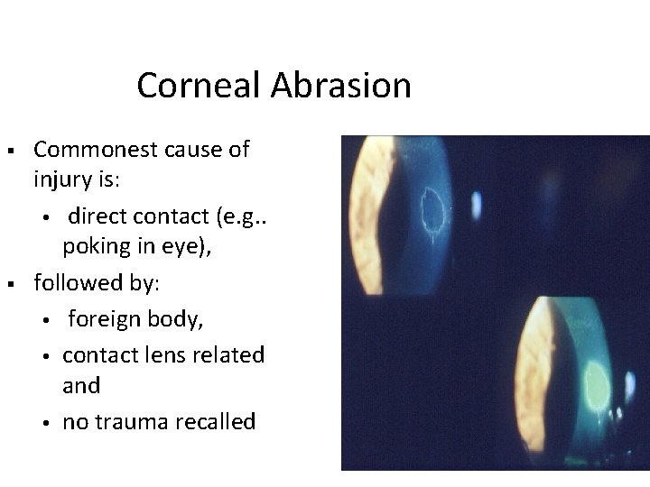 Corneal Abrasion Commonest cause of injury is: direct contact (e. g. . poking in