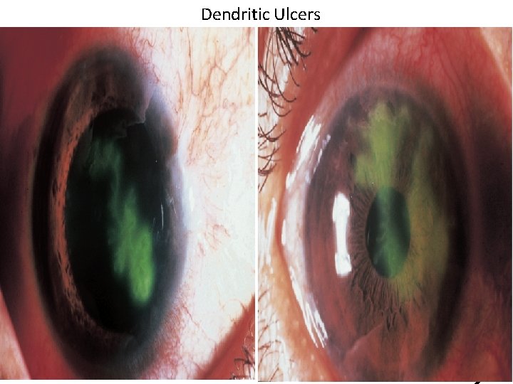 Dendritic Ulcers 5 