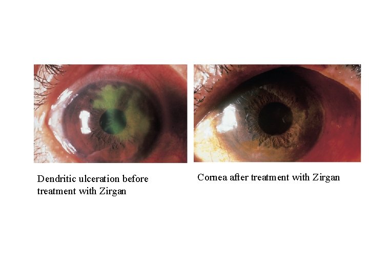 Dendritic ulceration before treatment with Zirgan Cornea after treatment with Zirgan 