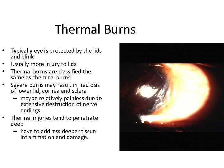 Thermal Burns • Typically eye is protected by the lids and blink • Usually