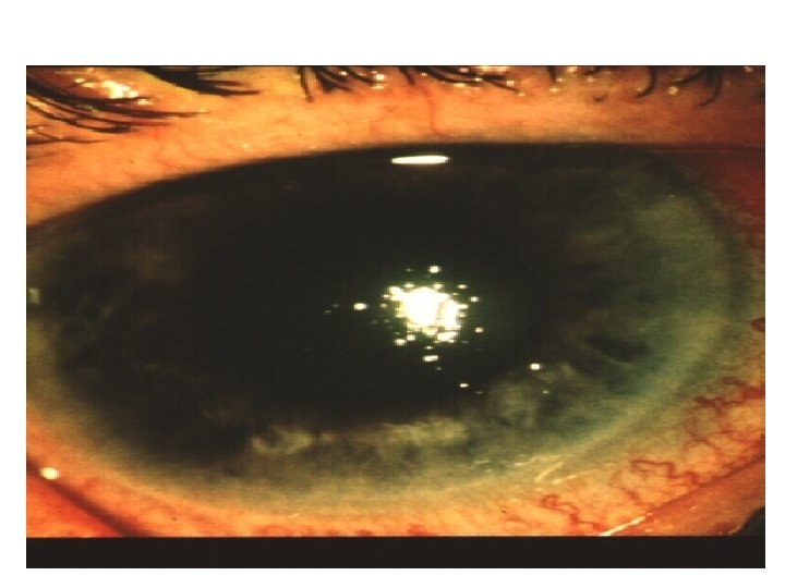 Acute Angle Closure-corneal edema and redness (circumlimbal) 