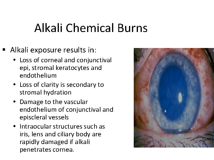 Alkali Chemical Burns Alkali exposure results in: Loss of corneal and conjunctival epi, stromal