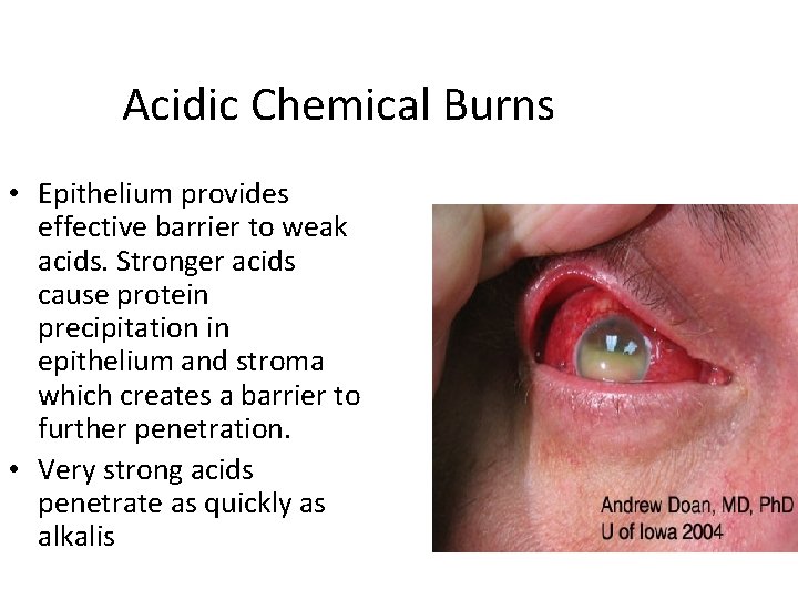 Acidic Chemical Burns • Epithelium provides effective barrier to weak acids. Stronger acids cause