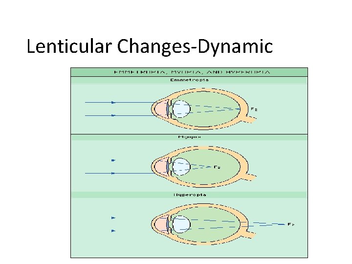 Lenticular Changes-Dynamic 