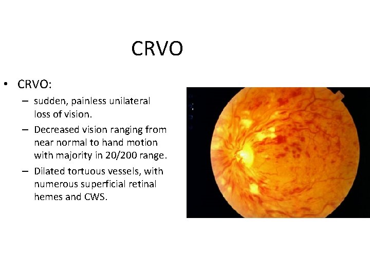 CRVO • CRVO: – sudden, painless unilateral loss of vision. – Decreased vision ranging