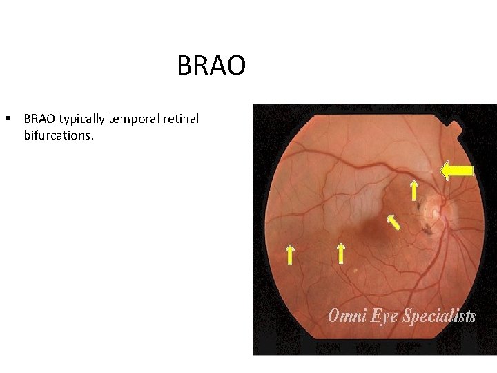 BRAO typically temporal retinal bifurcations. 