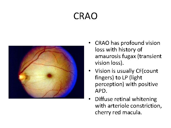 CRAO • CRAO has profound vision loss with history of amaurosis fugax (transient vision