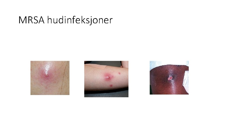 MRSA hudinfeksjoner 