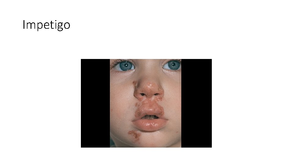 Impetigo 