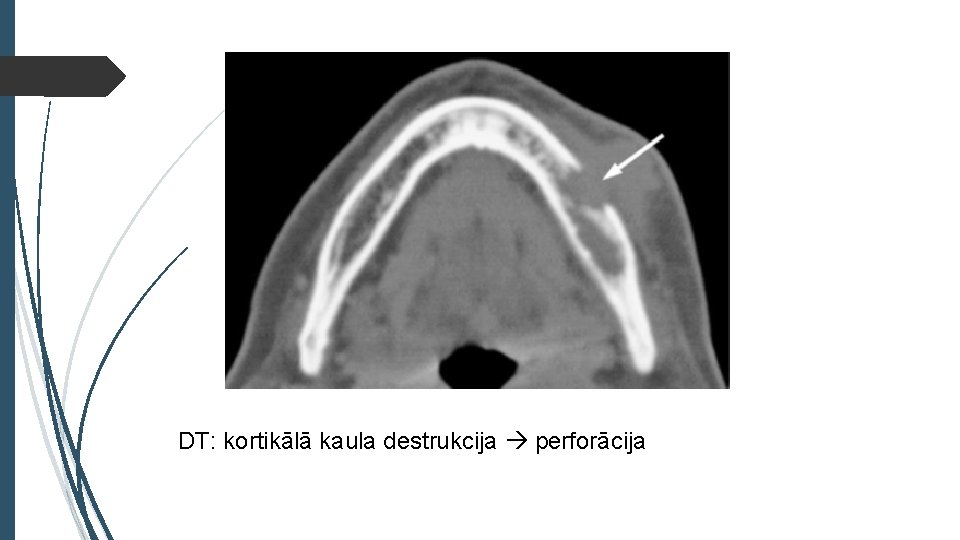 DT: kortikālā kaula destrukcija perforācija 