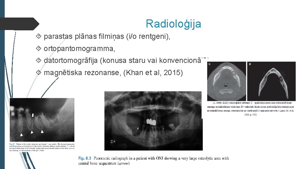 Radioloģija parastas plānas filmiņas (i/o rentgeni), ortopantomogramma, datortomogrāfija (konusa staru vai konvencionālā), magnētiska rezonanse,