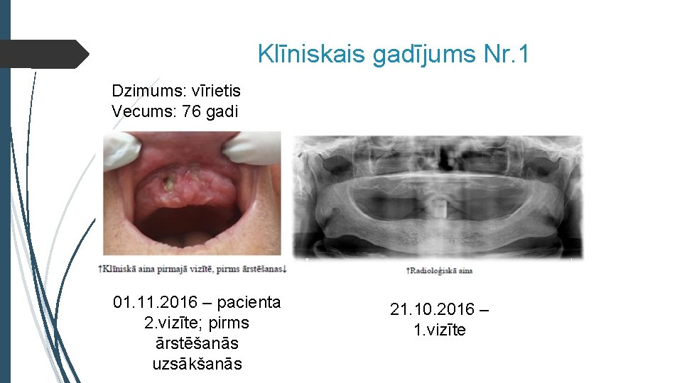 Klīniskais gadījums Nr. 1 Dzimums: vīrietis Vecums: 76 gadi 01. 11. 2016 – pacienta