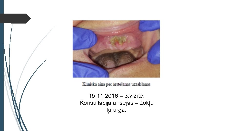 15. 11. 2016 – 3. vizīte. Konsultācija ar sejas – žokļu ķirurga. 