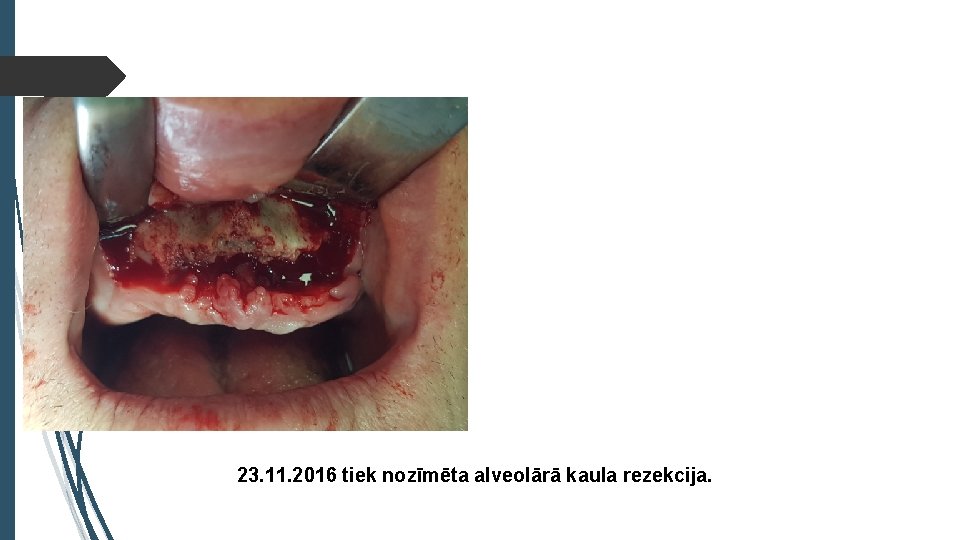 23. 11. 2016 tiek nozīmēta alveolārā kaula rezekcija. 