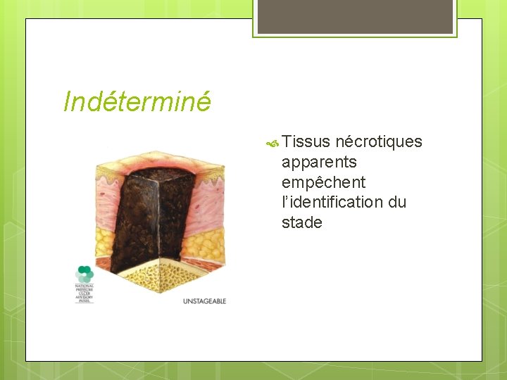 Indéterminé Tissus nécrotiques apparents empêchent l’identification du stade 