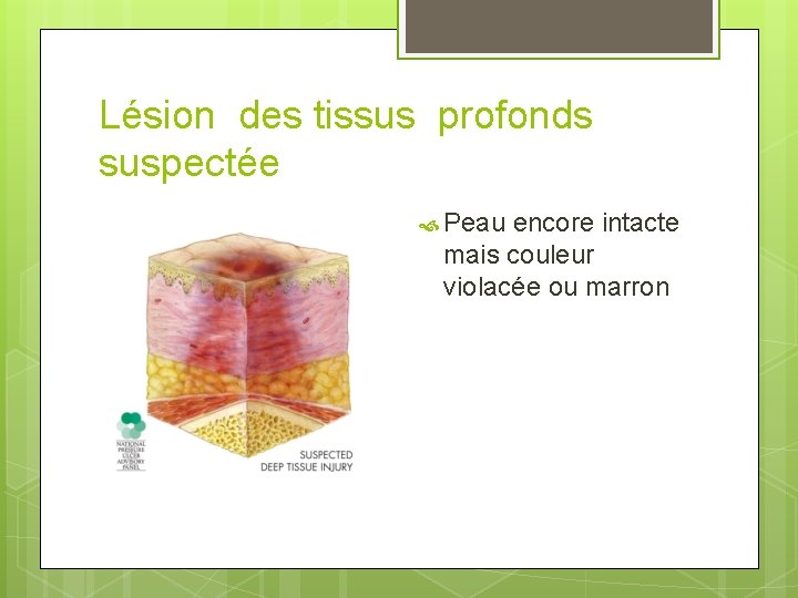 Lésion des tissus profonds suspectée Peau encore intacte mais couleur violacée ou marron 