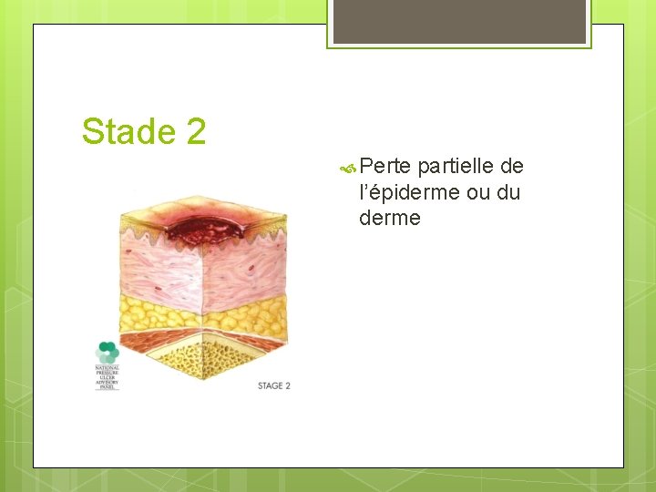 Stade 2 Perte partielle de l’épiderme ou du derme 