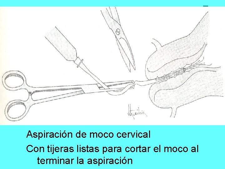 Aspiración de moco cervical Con tijeras listas para cortar el moco al terminar la