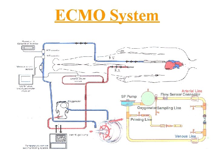 ECMO System 