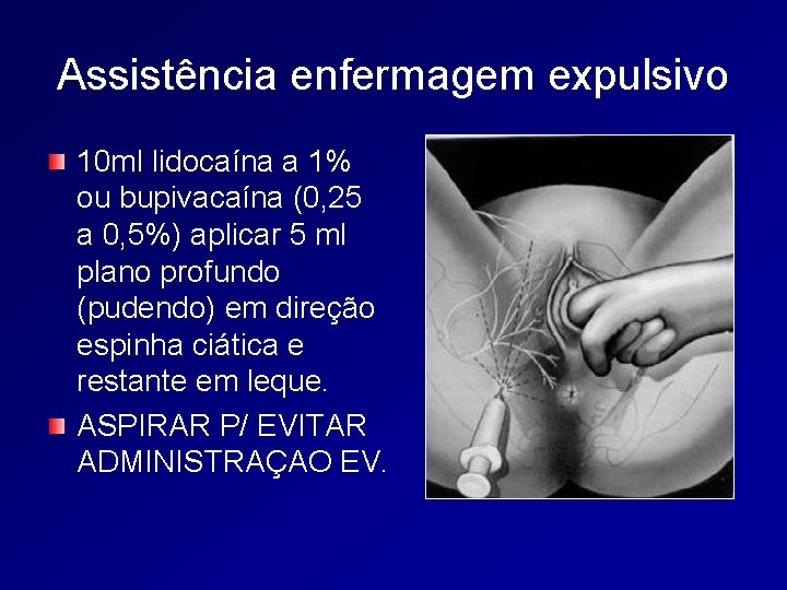 Assistência enfermagem expulsivo 10 ml lidocaína a 1% ou bupivacaína (0, 25 a 0,