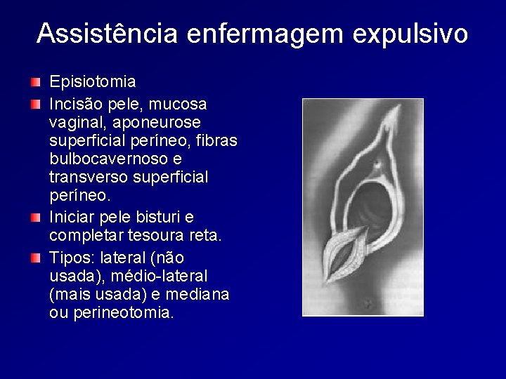 Assistência enfermagem expulsivo Episiotomia Incisão pele, mucosa vaginal, aponeurose superficial períneo, fibras bulbocavernoso e