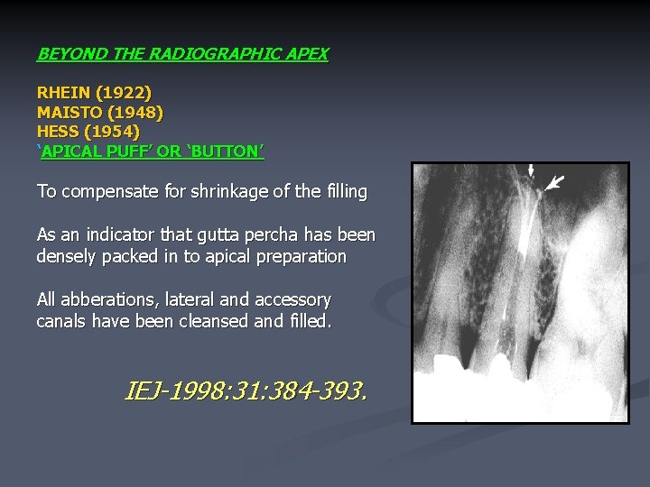 BEYOND THE RADIOGRAPHIC APEX RHEIN (1922) MAISTO (1948) HESS (1954) ‘APICAL PUFF’ OR ‘BUTTON’