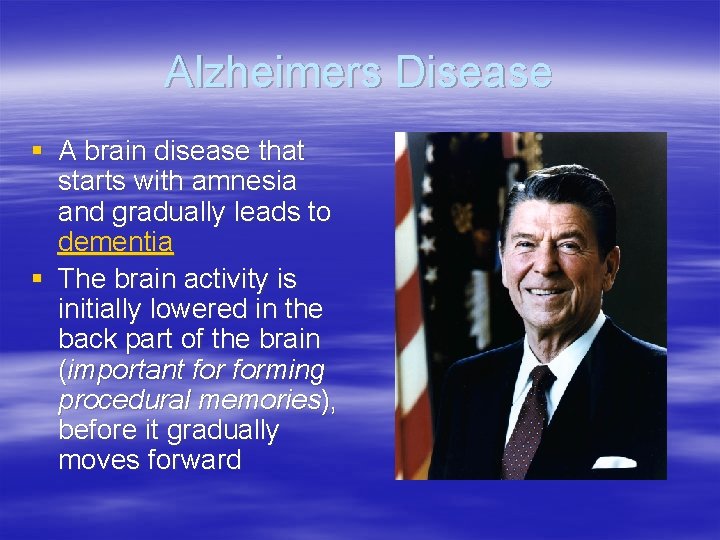 Alzheimers Disease § A brain disease that starts with amnesia and gradually leads to