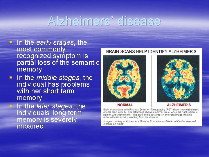 Alzheimers’ disease § In the early stages, the most commonly recognized symptom is partial