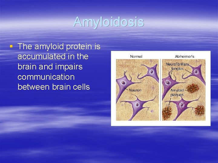 Amyloidosis § The amyloid protein is accumulated in the brain and impairs communication between