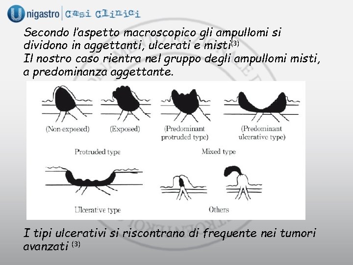 Secondo l’aspetto macroscopico gli ampullomi si dividono in aggettanti, ulcerati e misti(3) Il nostro