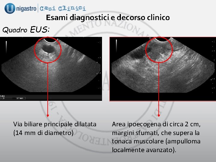 Esami diagnostici e decorso clinico Quadro EUS: Via biliare principale dilatata (14 mm di